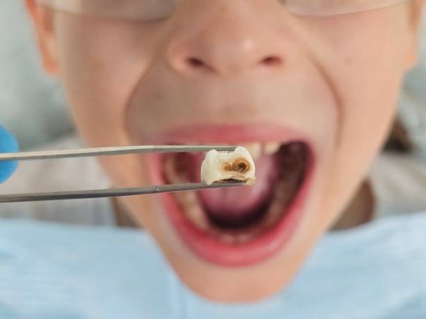 Best Broken or Cracked Tooth Emergency Dentist in Channelview, TX